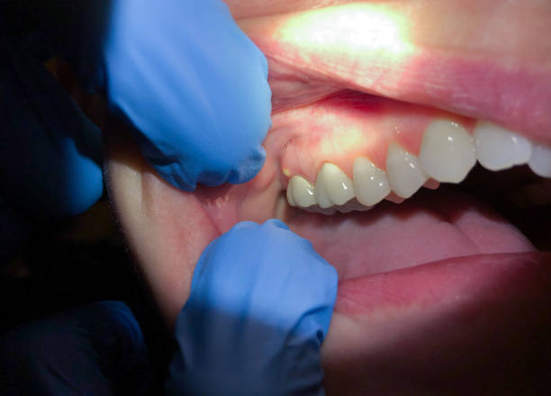 Best Emergency Dental Care for Broken or Chipped Teeth in Southgate, KY